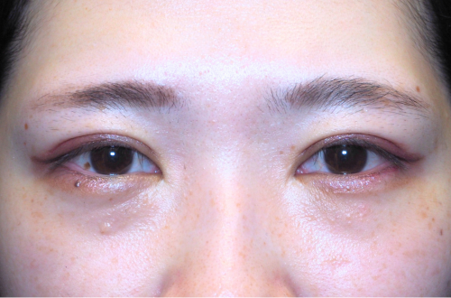 二重切開法(30代|女性)3ヶ月後