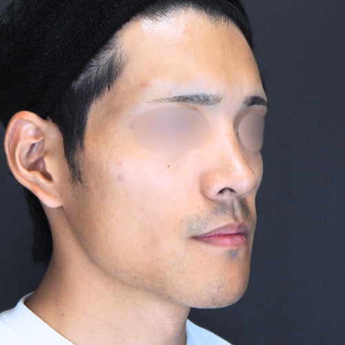 オトガイ形成（20代｜男性）6ヶ月後