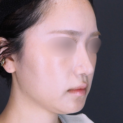 セットバック整形（20代｜女性）6ヶ月後