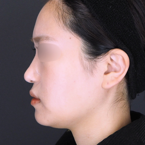 下セットバック＋オトガイ広範囲骨切り術の術前