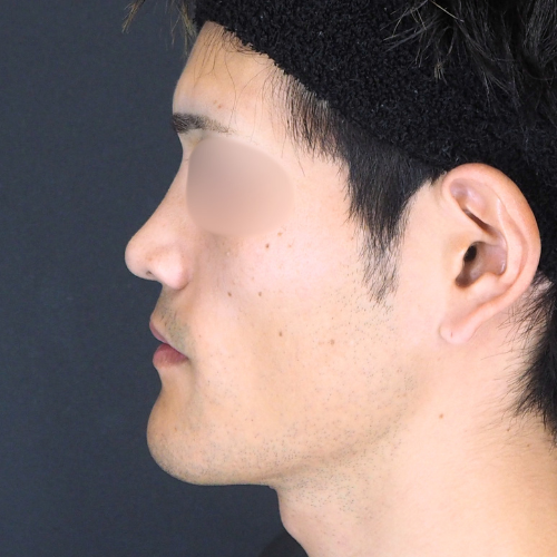 オトガイ形成（20代｜男性）