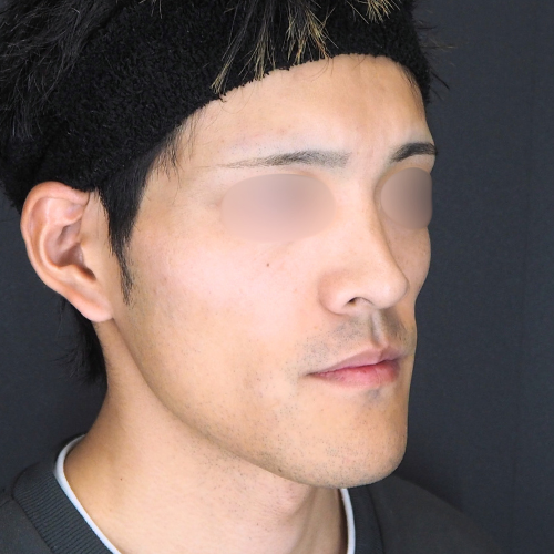 オトガイ形成（20代｜男性）
