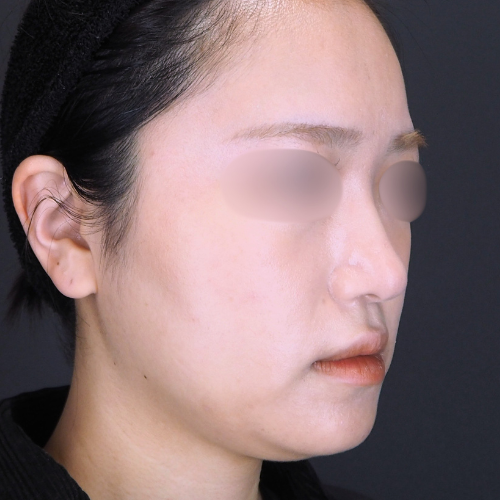 セットバック整形（20代｜女性）