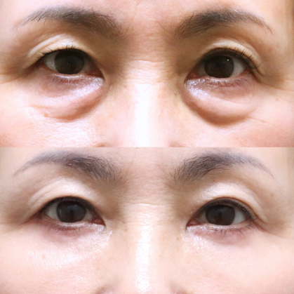 目の下のたるみ取りはこんな方に効果的
