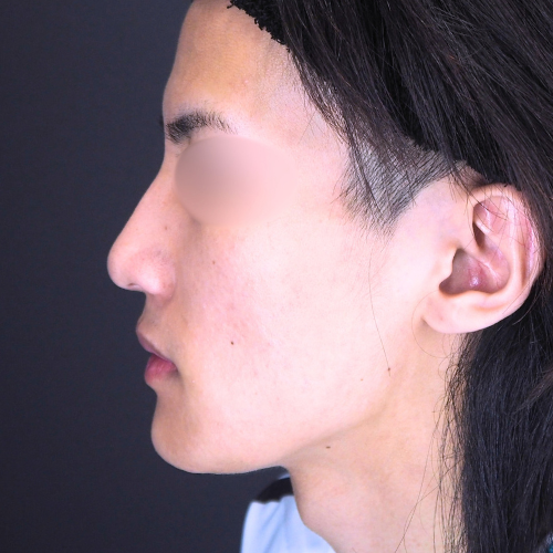 セットバック整形（20代｜男性）6ヶ月後