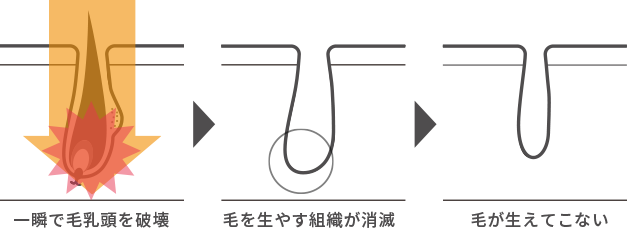 医療脱毛の図解