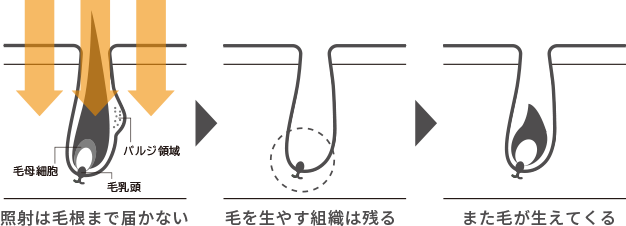 エステ脱毛の図解
