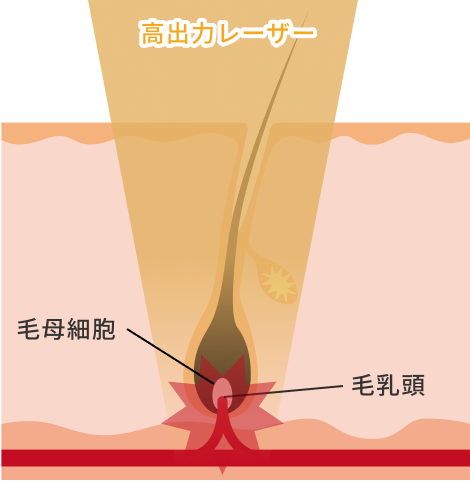 熱破壊式医療脱毛のイメージ図