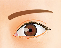 目の下のラインに沿って余剰皮膚を切除して目頭の涙丘を露出させて縫合する。