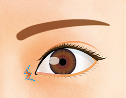 目頭に近い箇所の皮膚をW型に切開・切除する。
