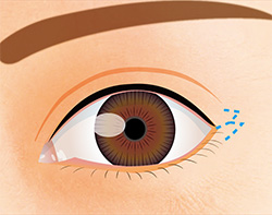 白目を隠している皮膚・結膜をW型に数ミリ切開する。