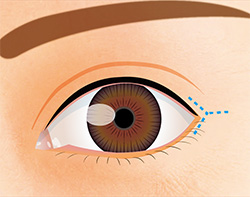 白目を隠している皮膚・結膜をY型に3～5㎜切開する。